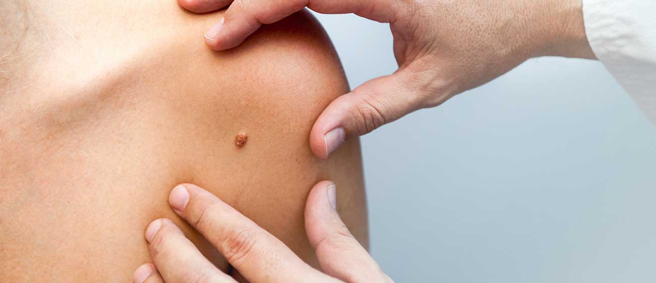 Удаление папиллом